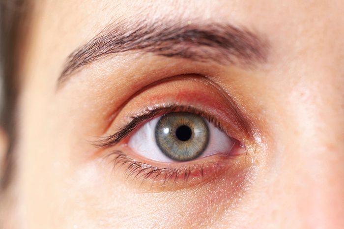close up of green eye with discoloration in the eyelid
