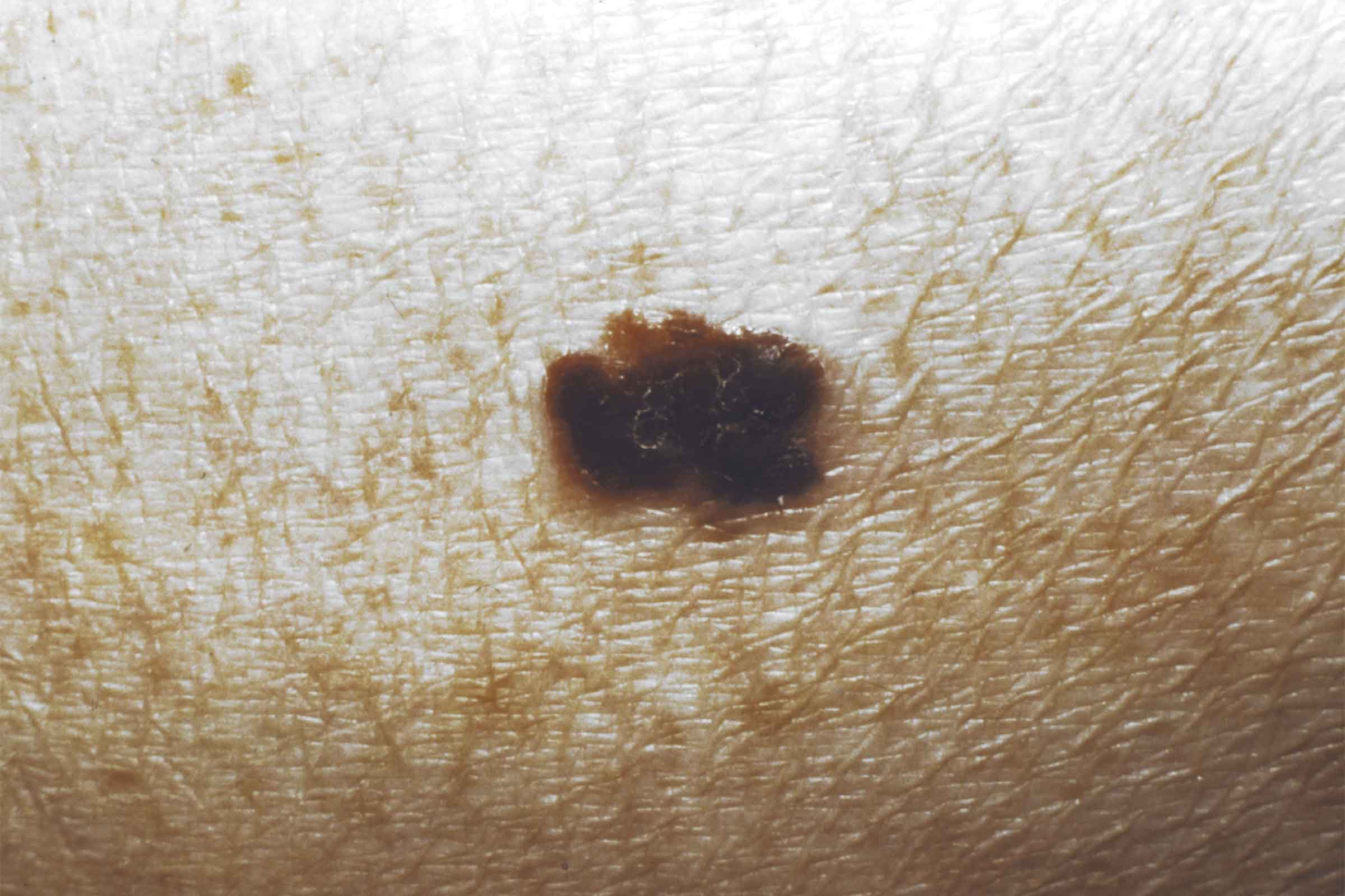 brown asymmetrical mole