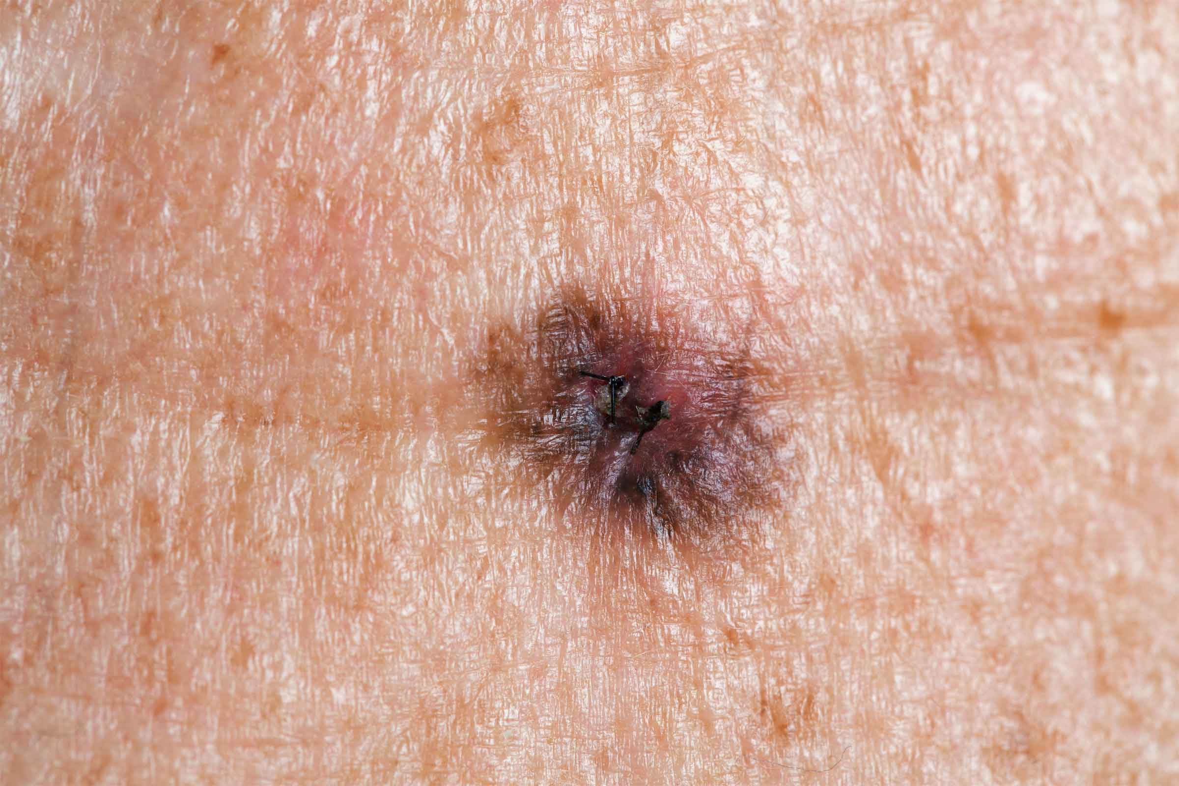 brown mole with poorly defined borders