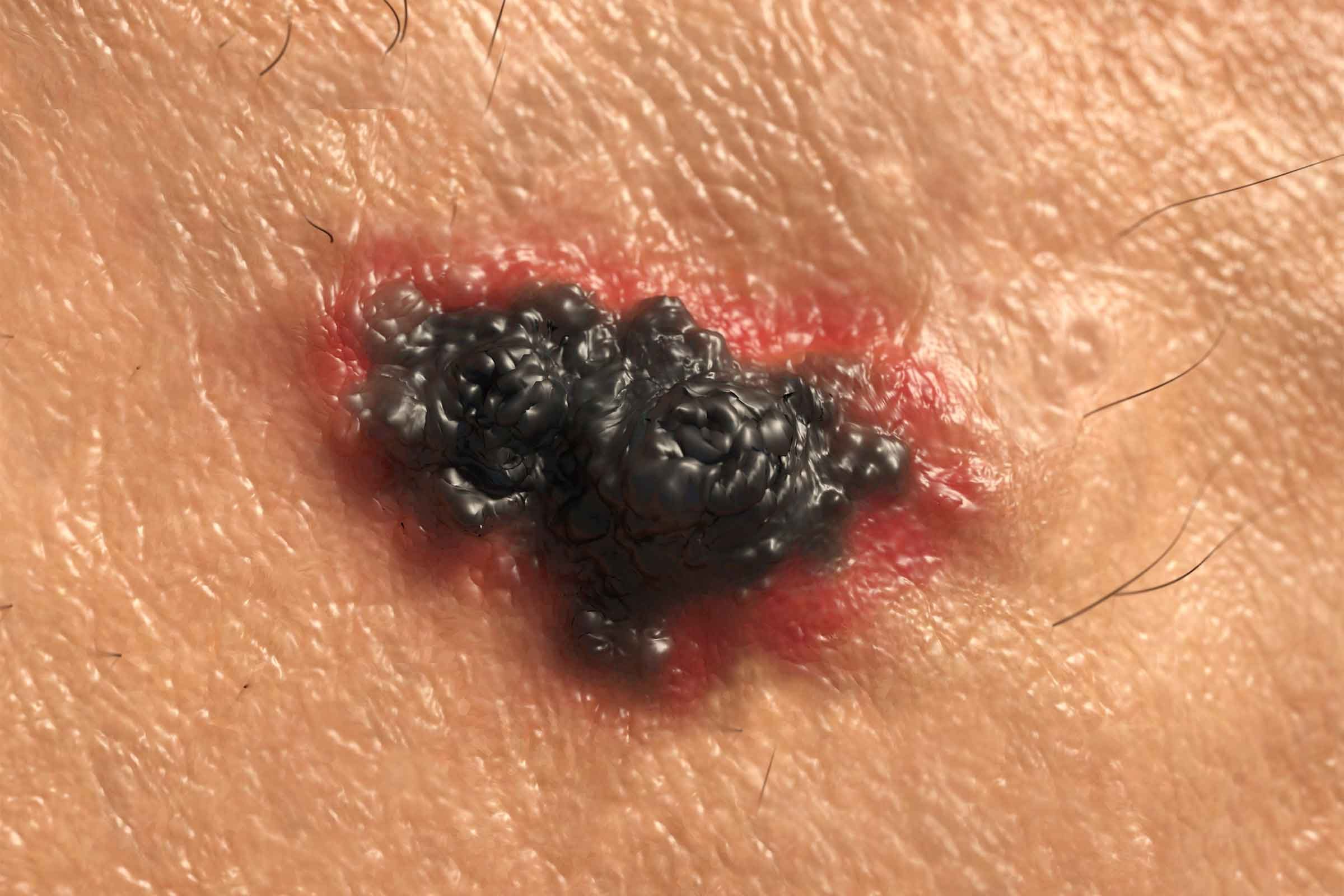 mole with red outside and dark interior