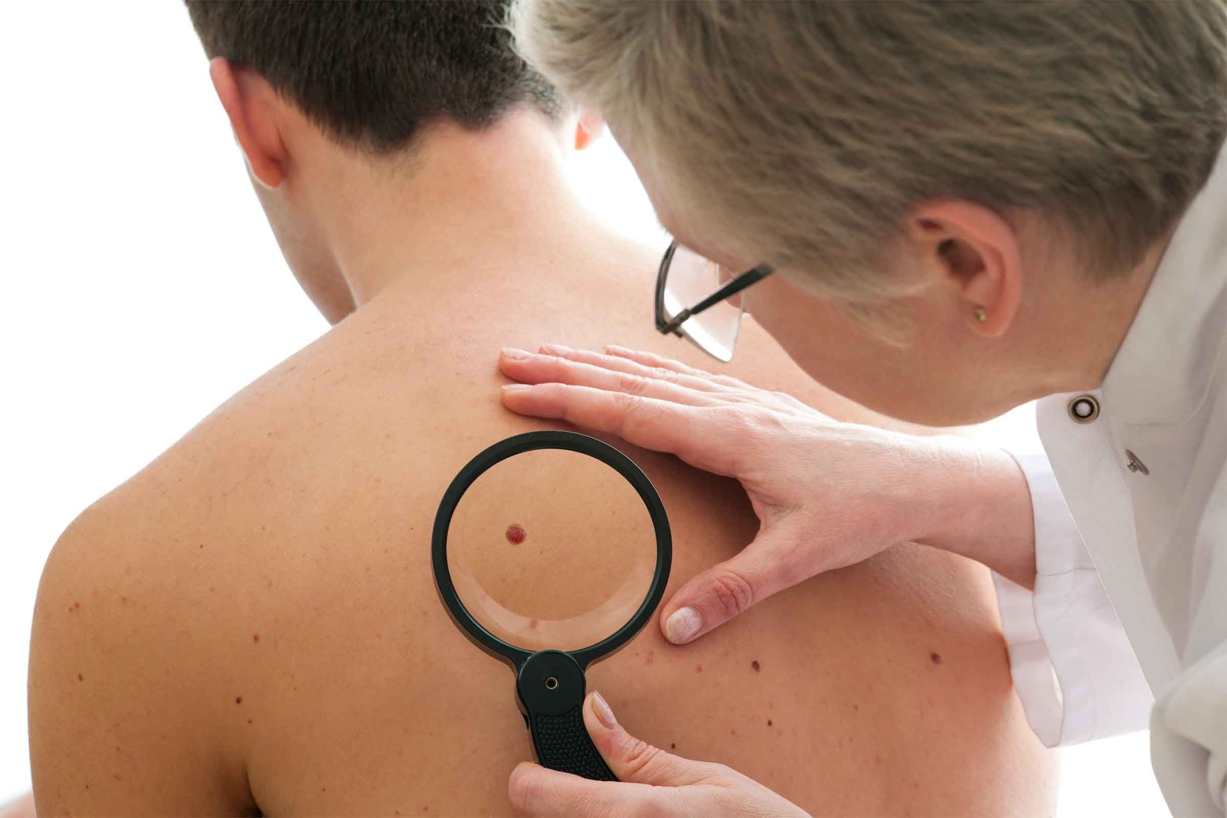 male doctor looking at mole with magnifying glass on man's back