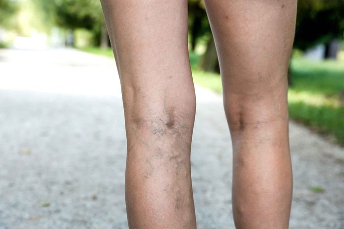 07-high-heels-varicose-veins
