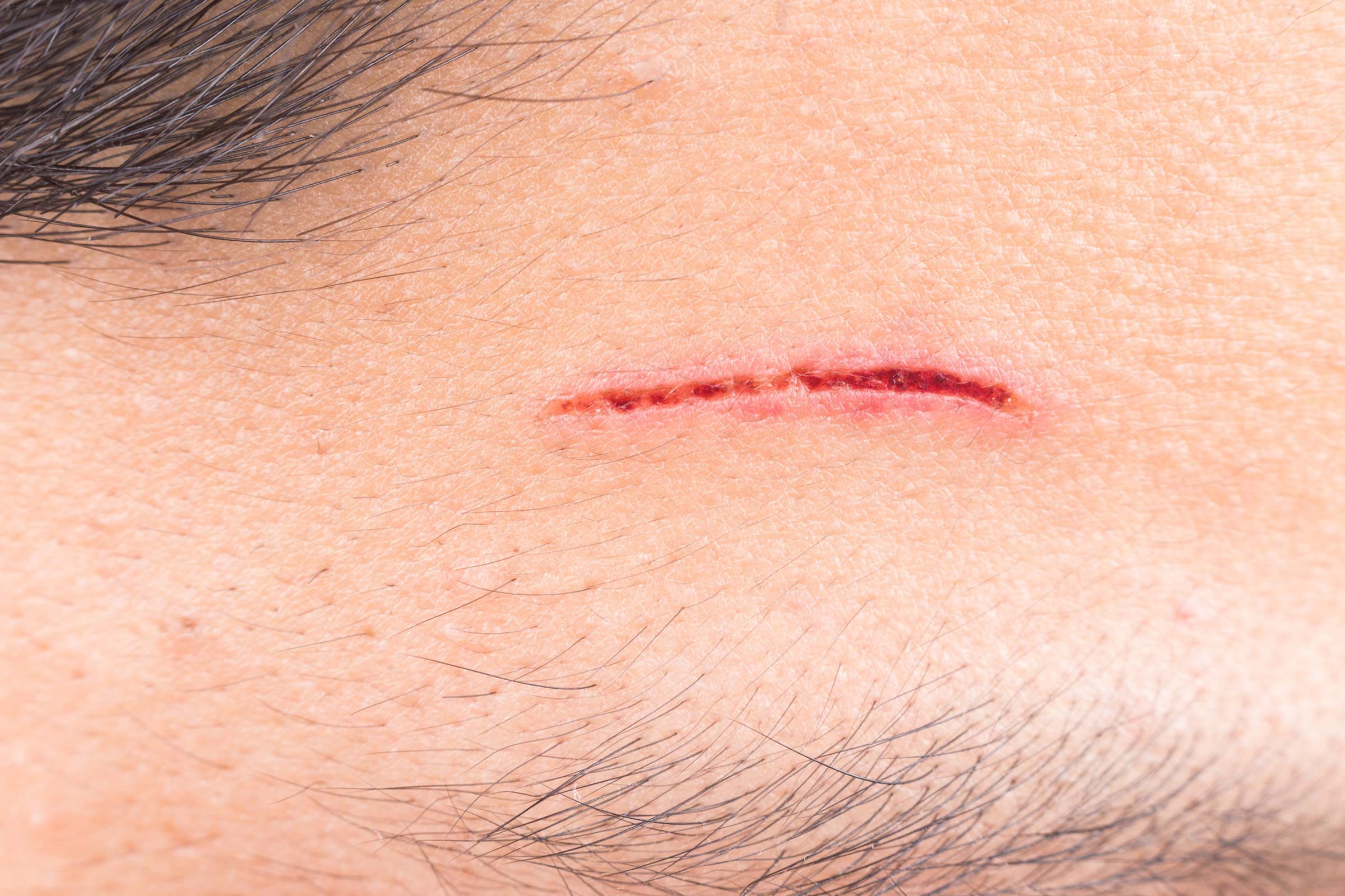 05-is-that-cut-or-scrape-infected