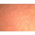 Whatâ€™s That Rash? How to ID 14 of the Most Common Skin Irritations
