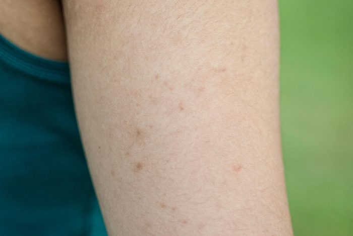 Bumps on someone's upper arm.