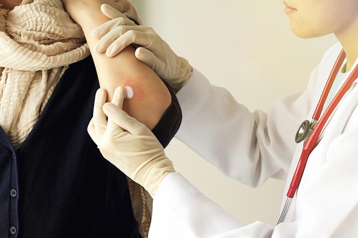 eczema