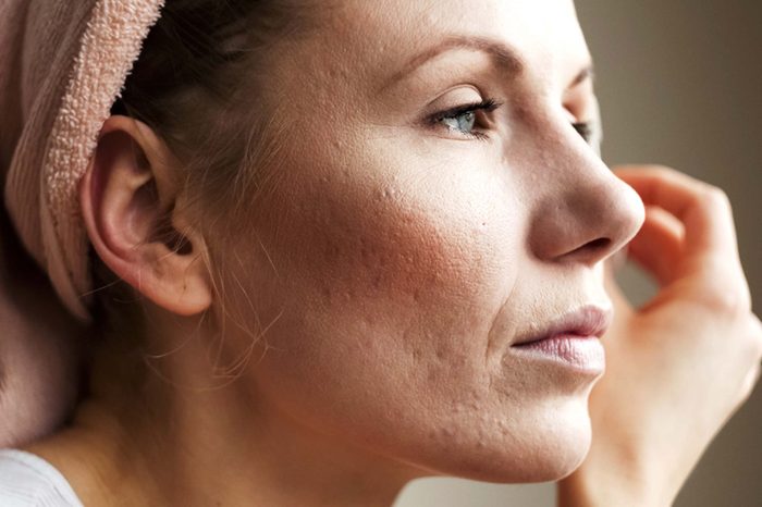 woman with rough skin and a towel around her head