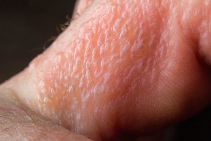 poison ivy rash