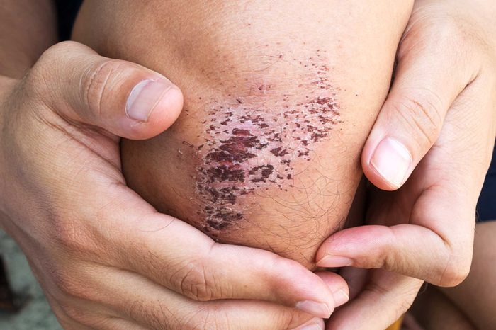 scab on knee