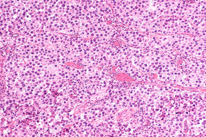 testicularcancer