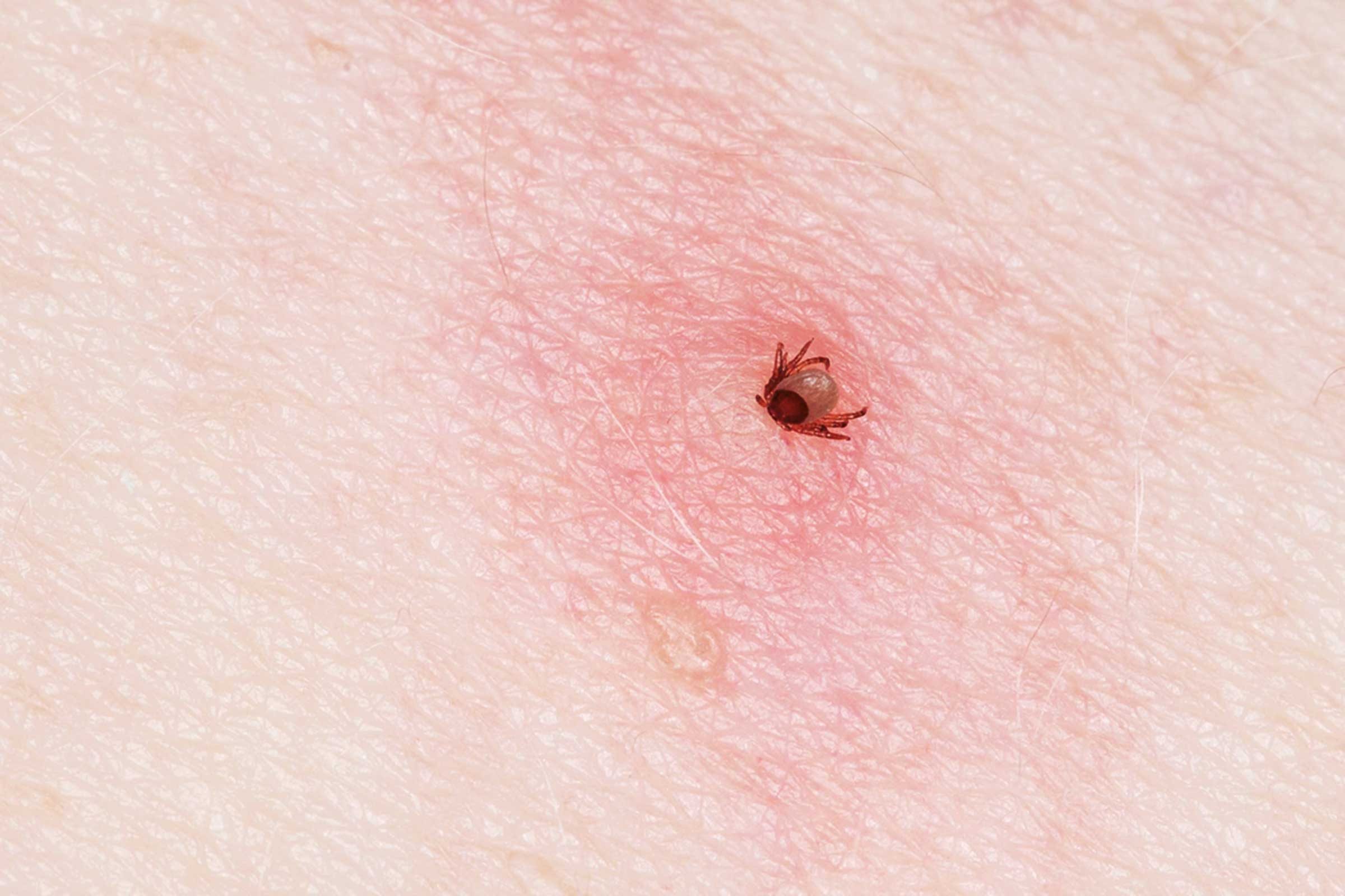 how to identify tick bites