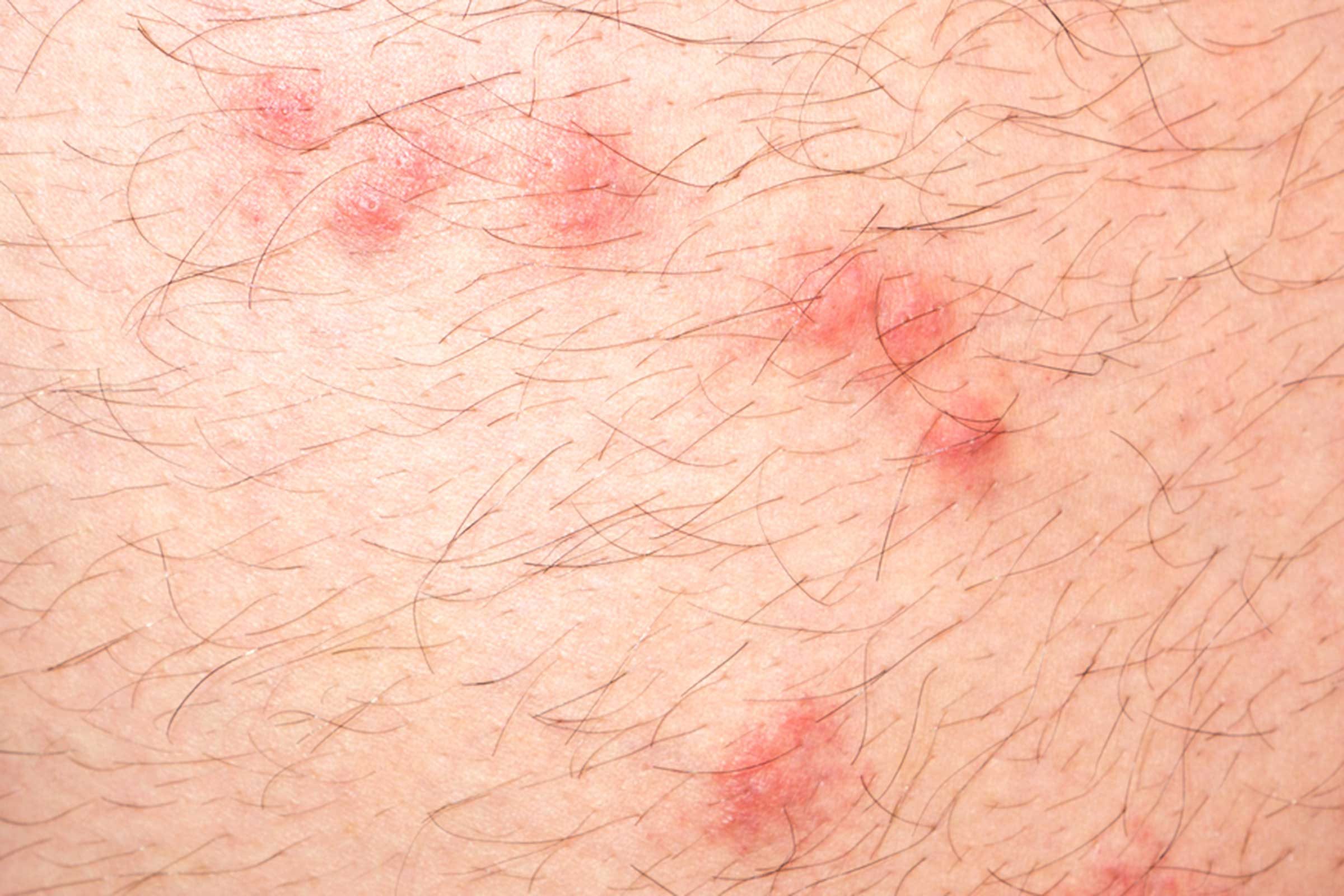 how to identify flea bites on human skin