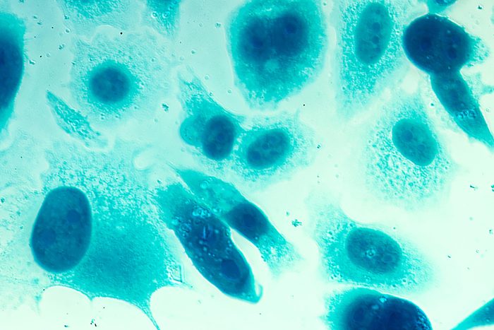 cancercell