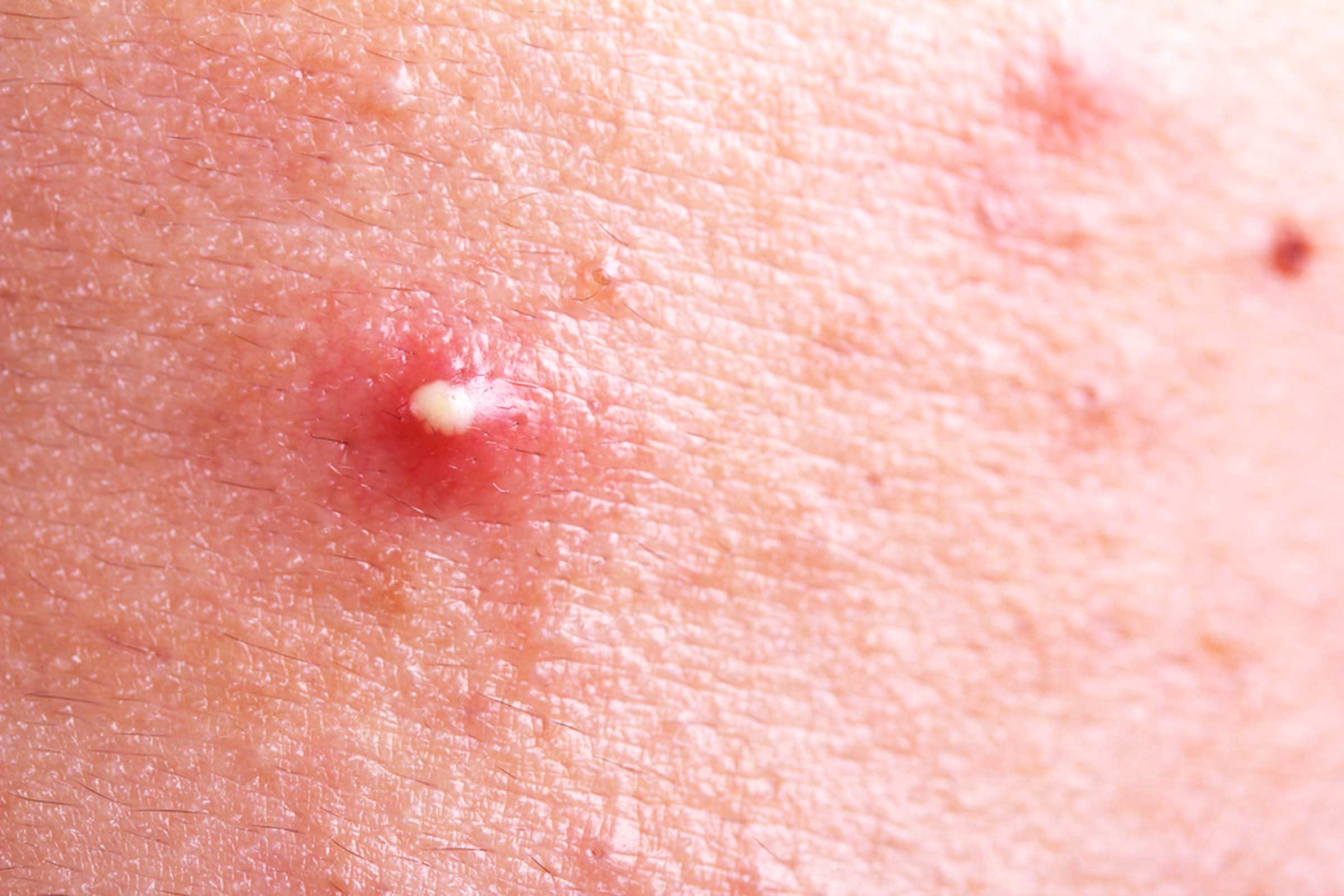 how to identify fire ant bites on human skin