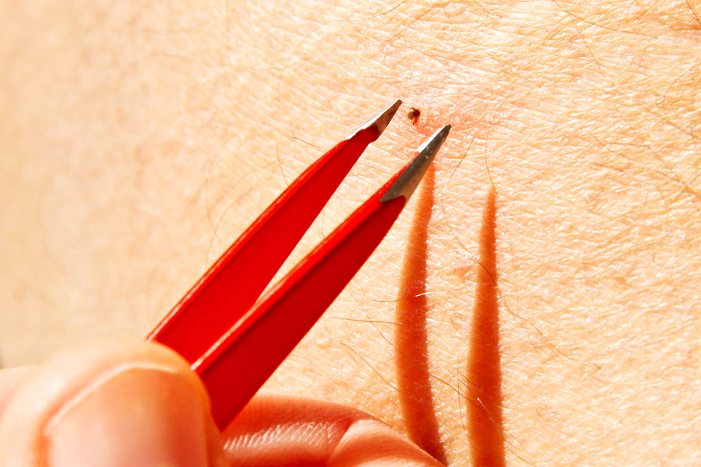 Tweezers and a tick 