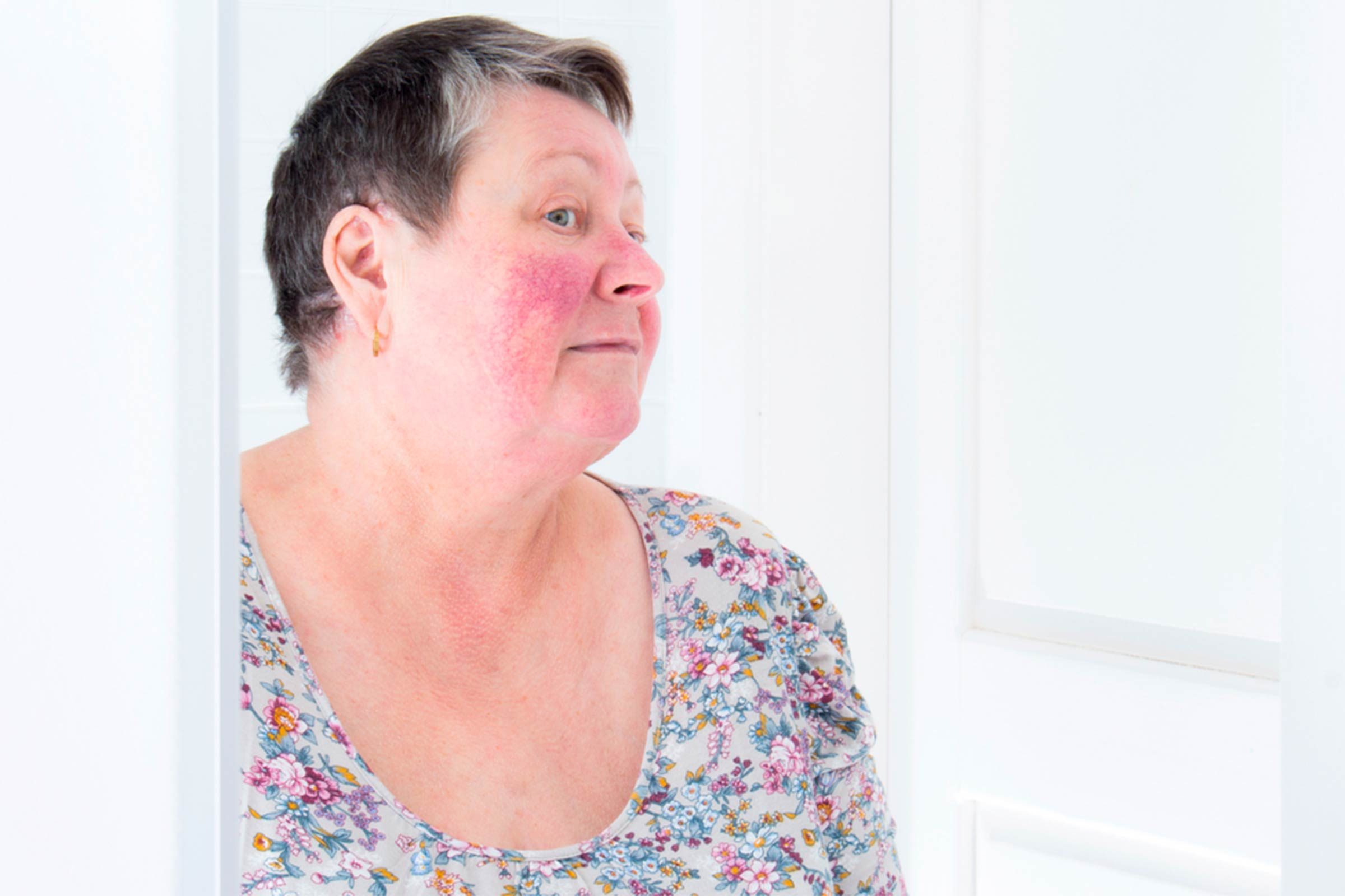 woman with rosacea looking in a mirror