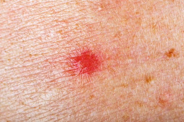 red-spot