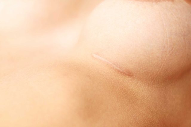 scar