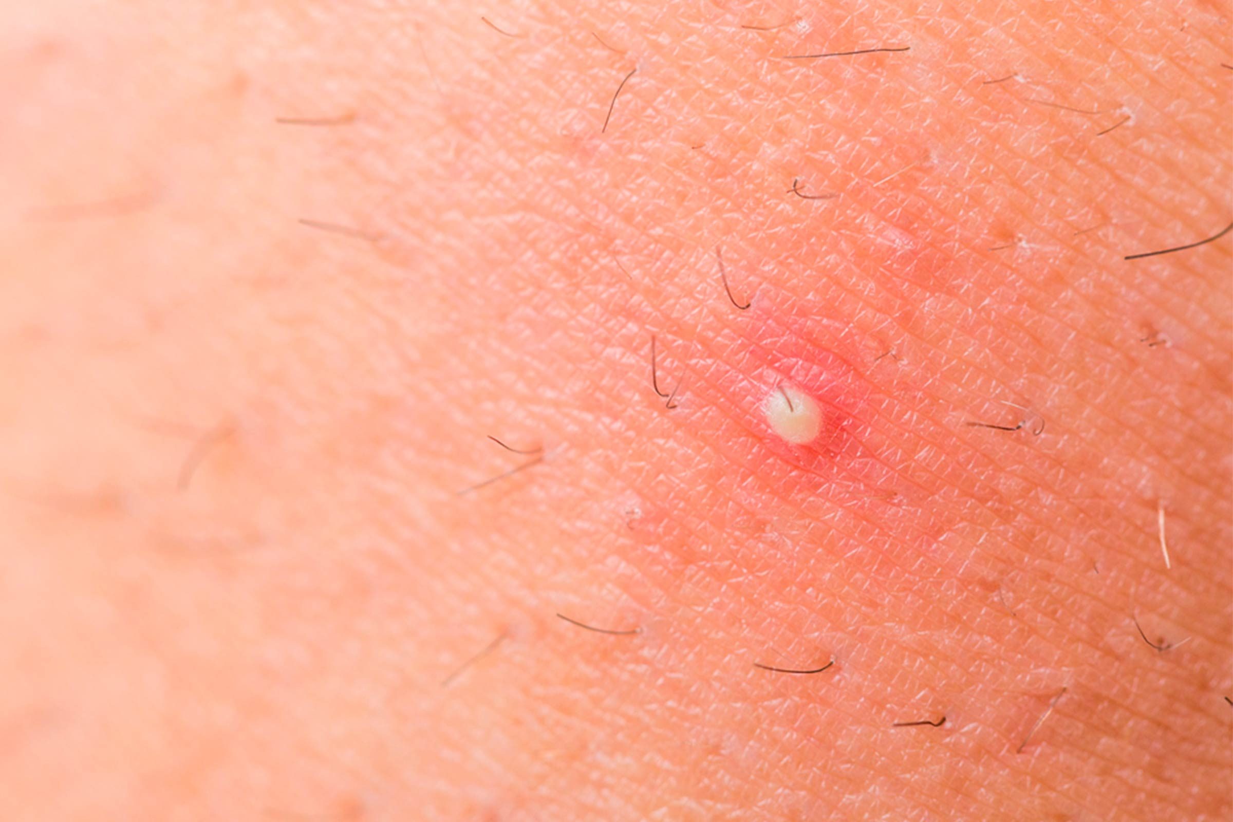 ingrown hair