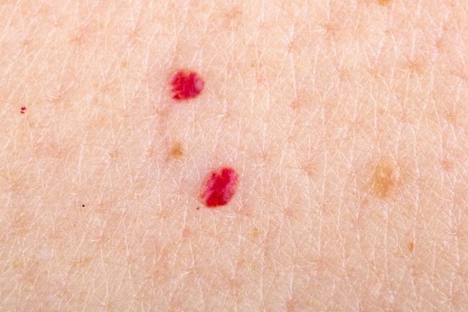Closeup of cherry angiomas.