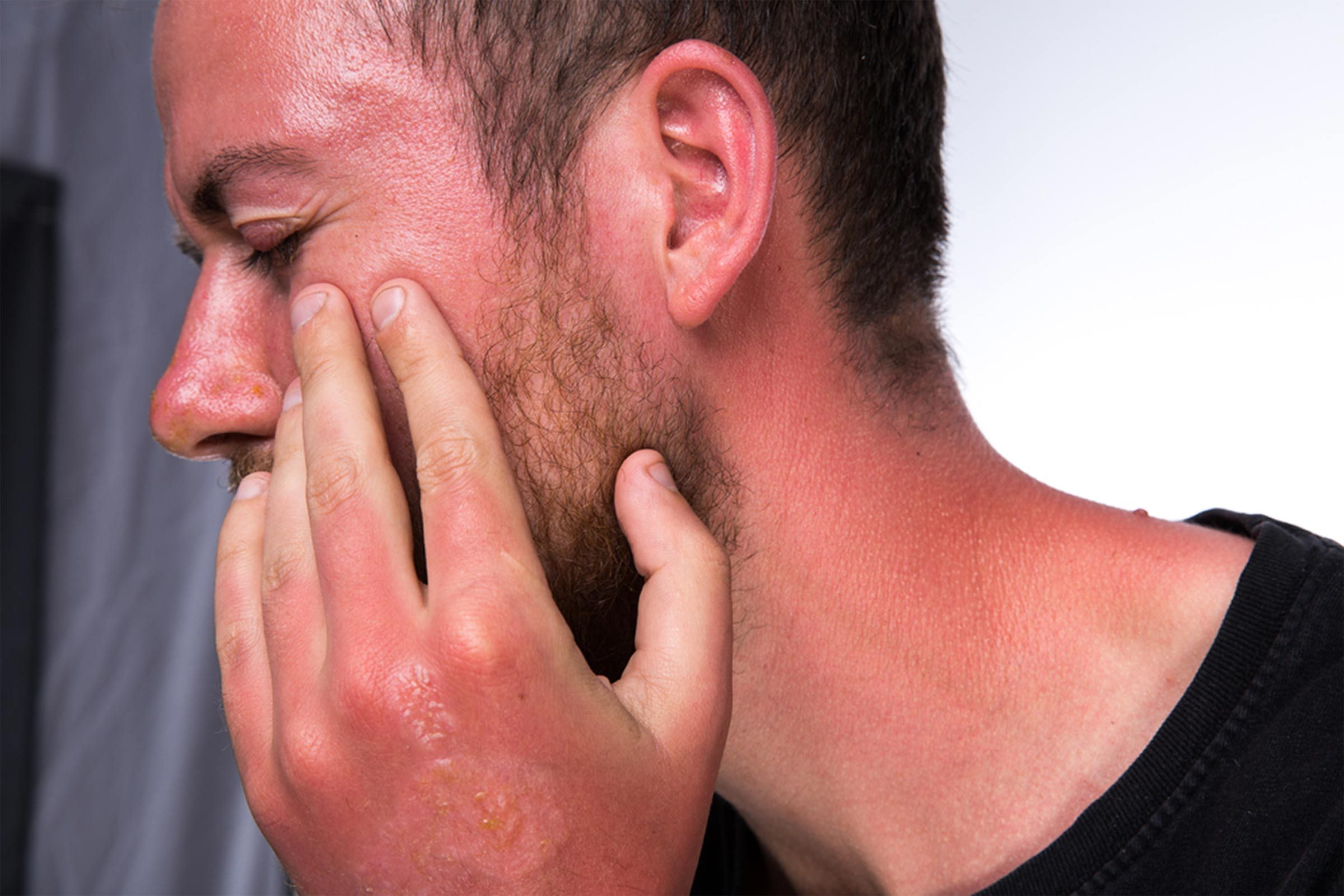 guy with terrible sunburn