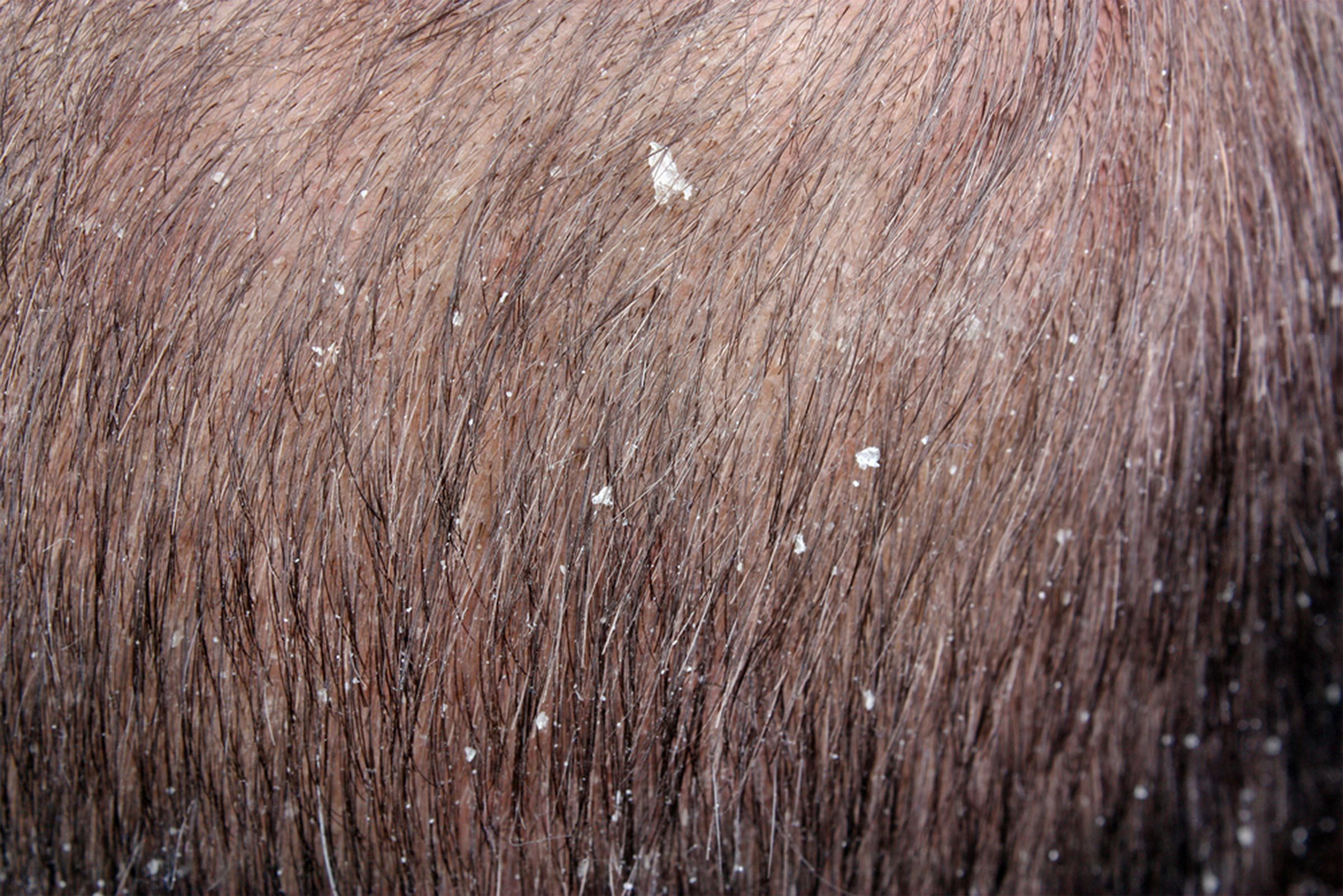 dandruff in hair 