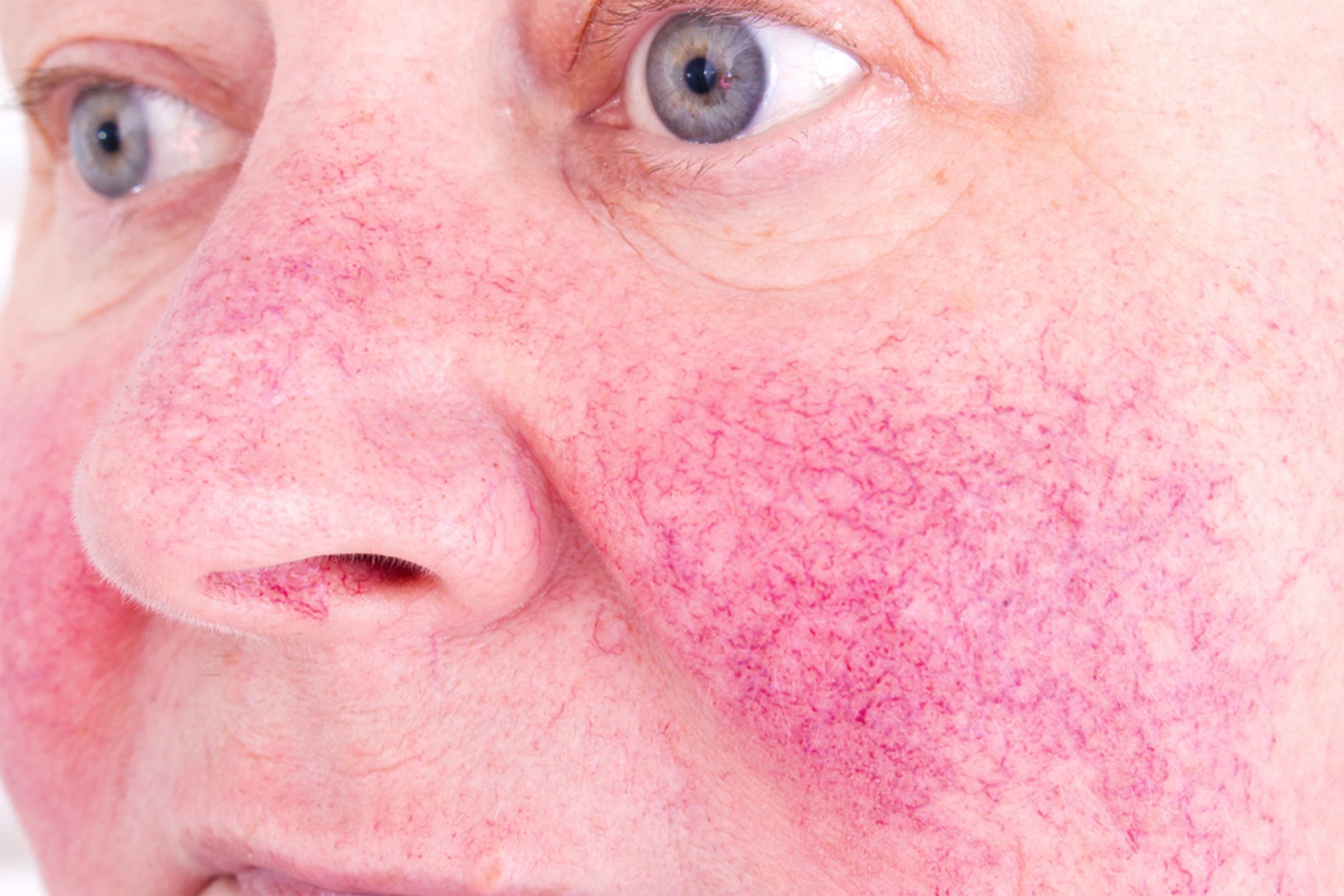 man with rosecea on cheeks and nose