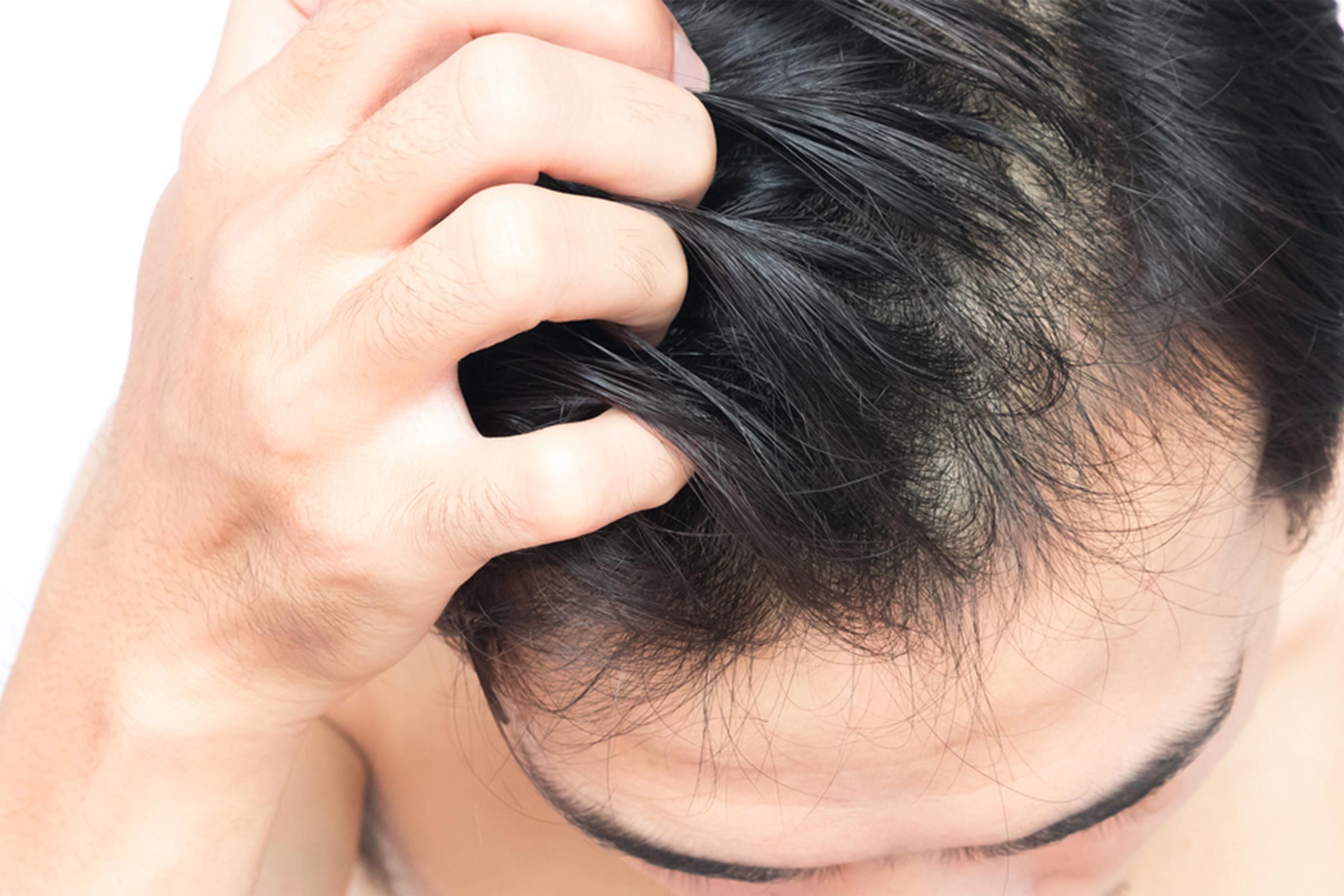main itching hair on head