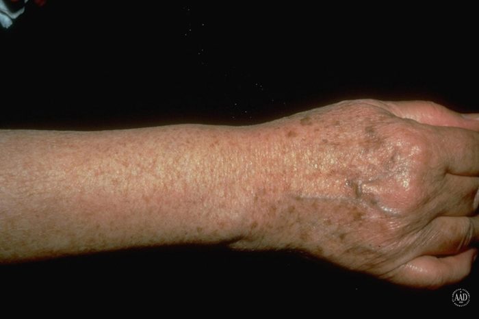 Arm and hand that has sunspots on it.