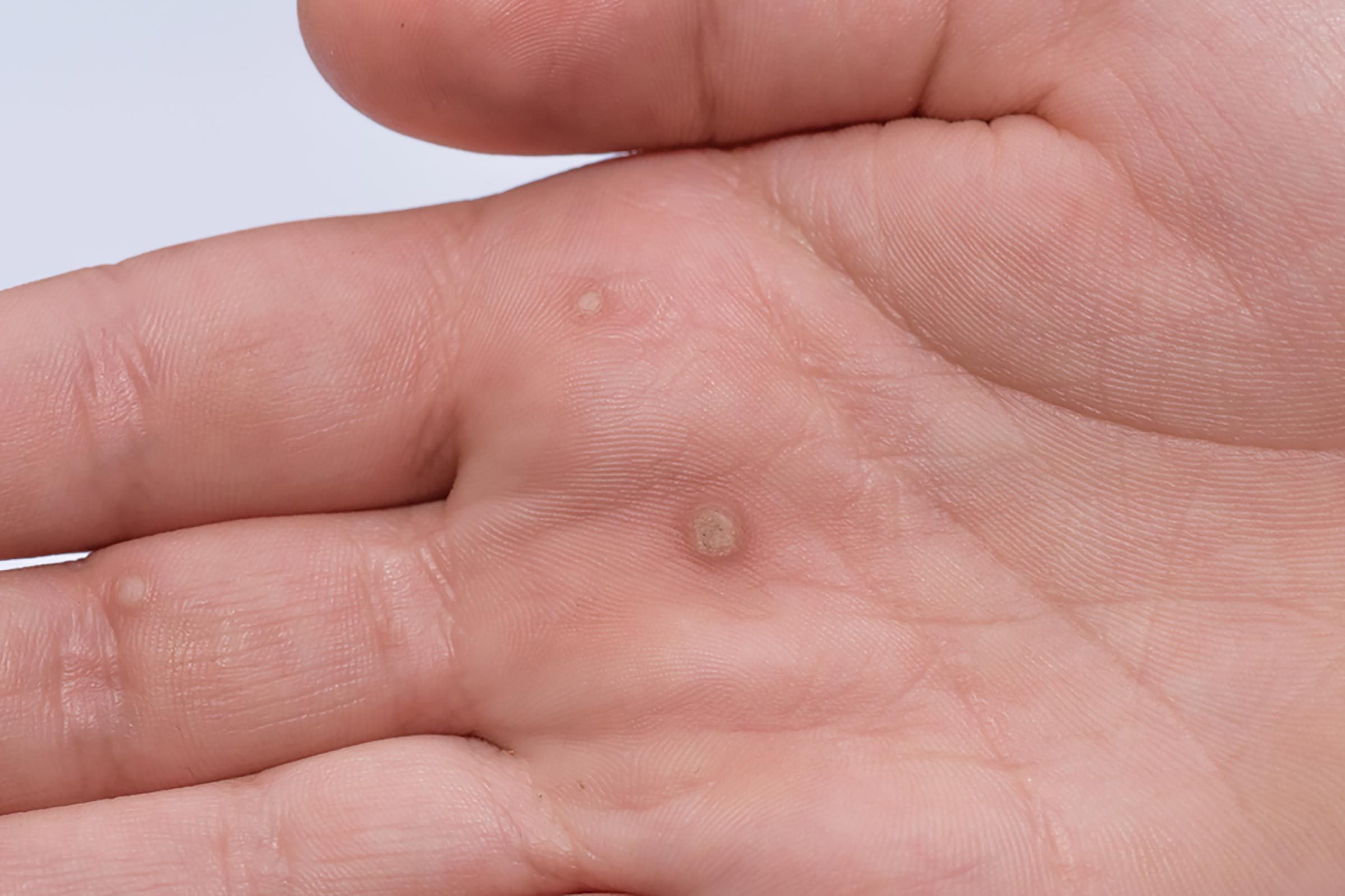 close up of a wart on the palm of the hand