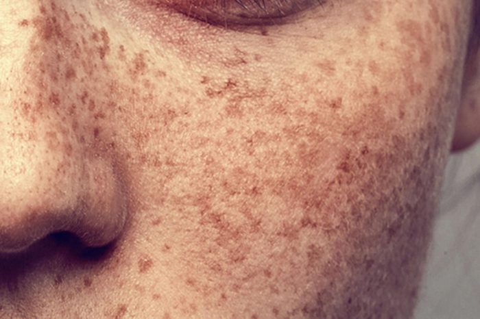 Face that contains freckles on the cheeks and nose.