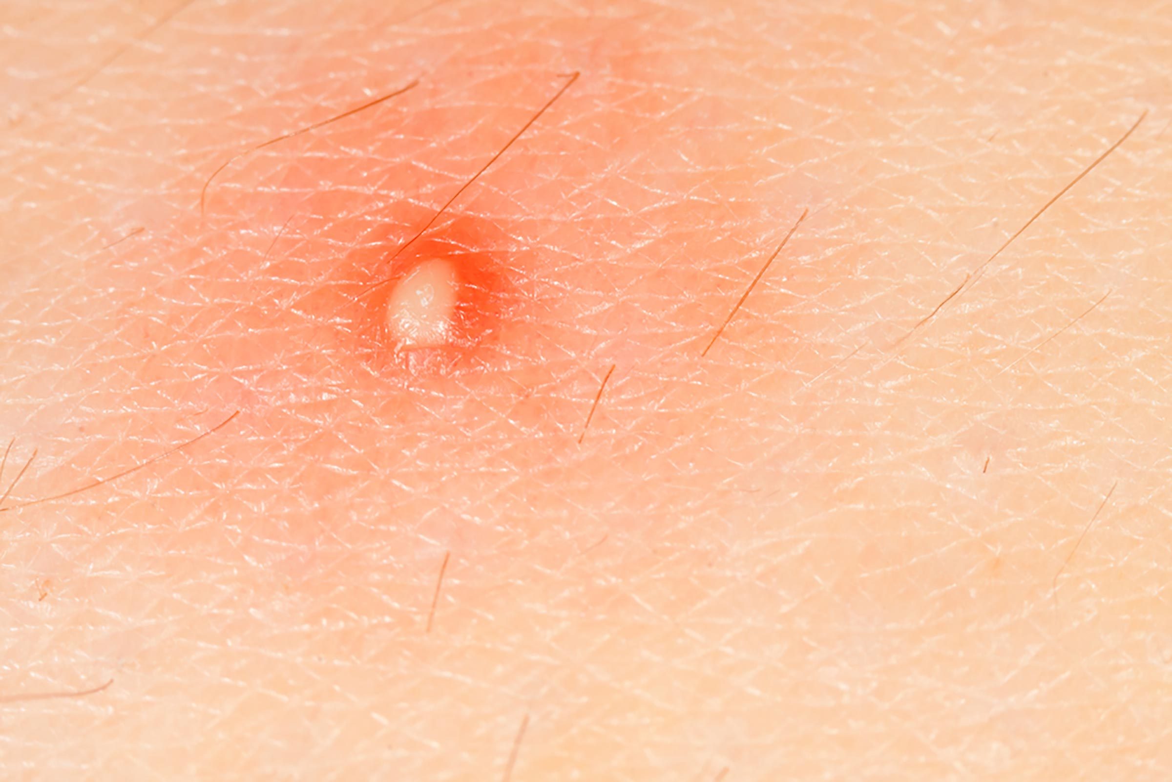 close up of a boil