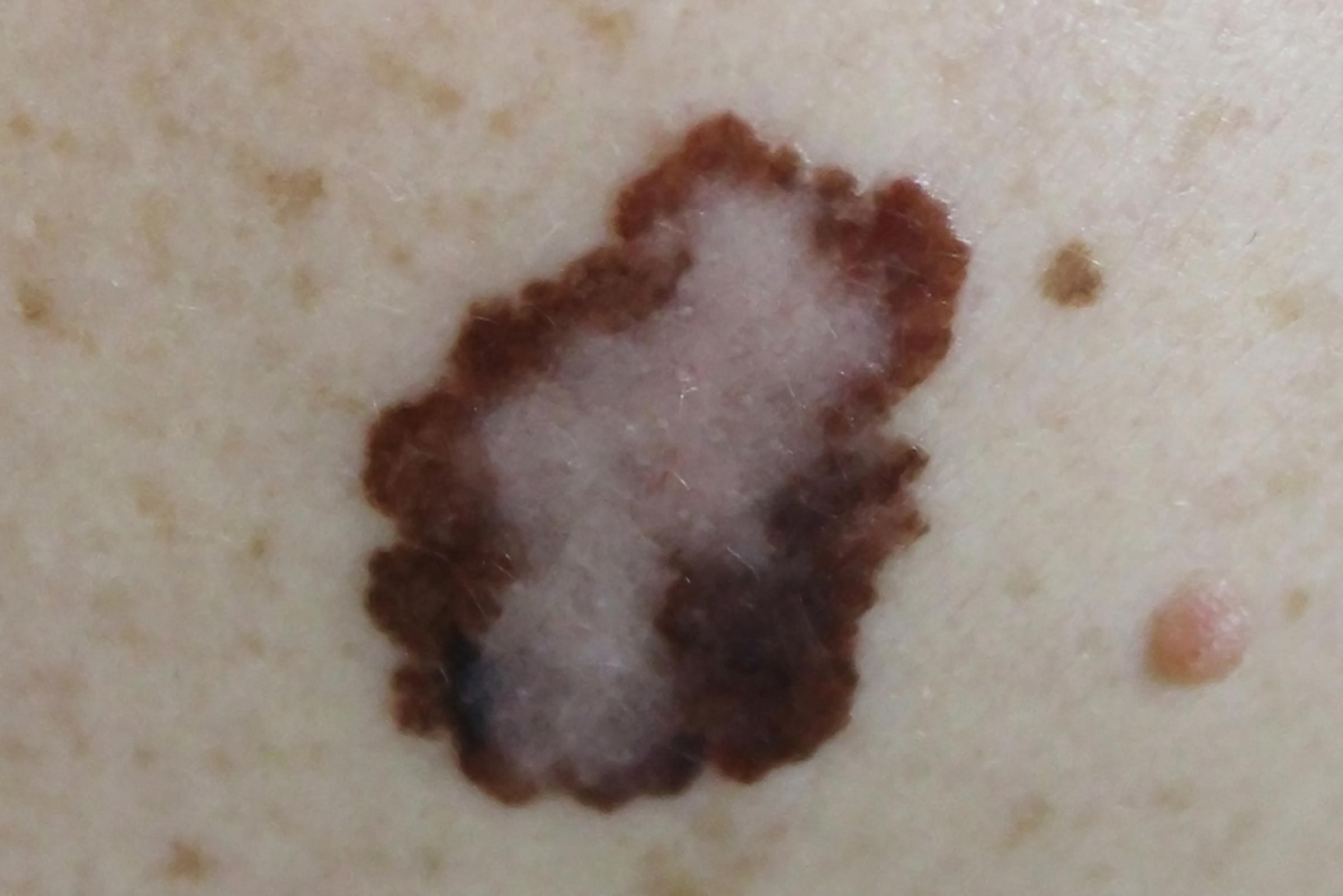 close up of a suspicious mole
