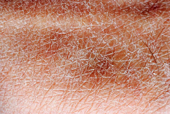 Dry skin