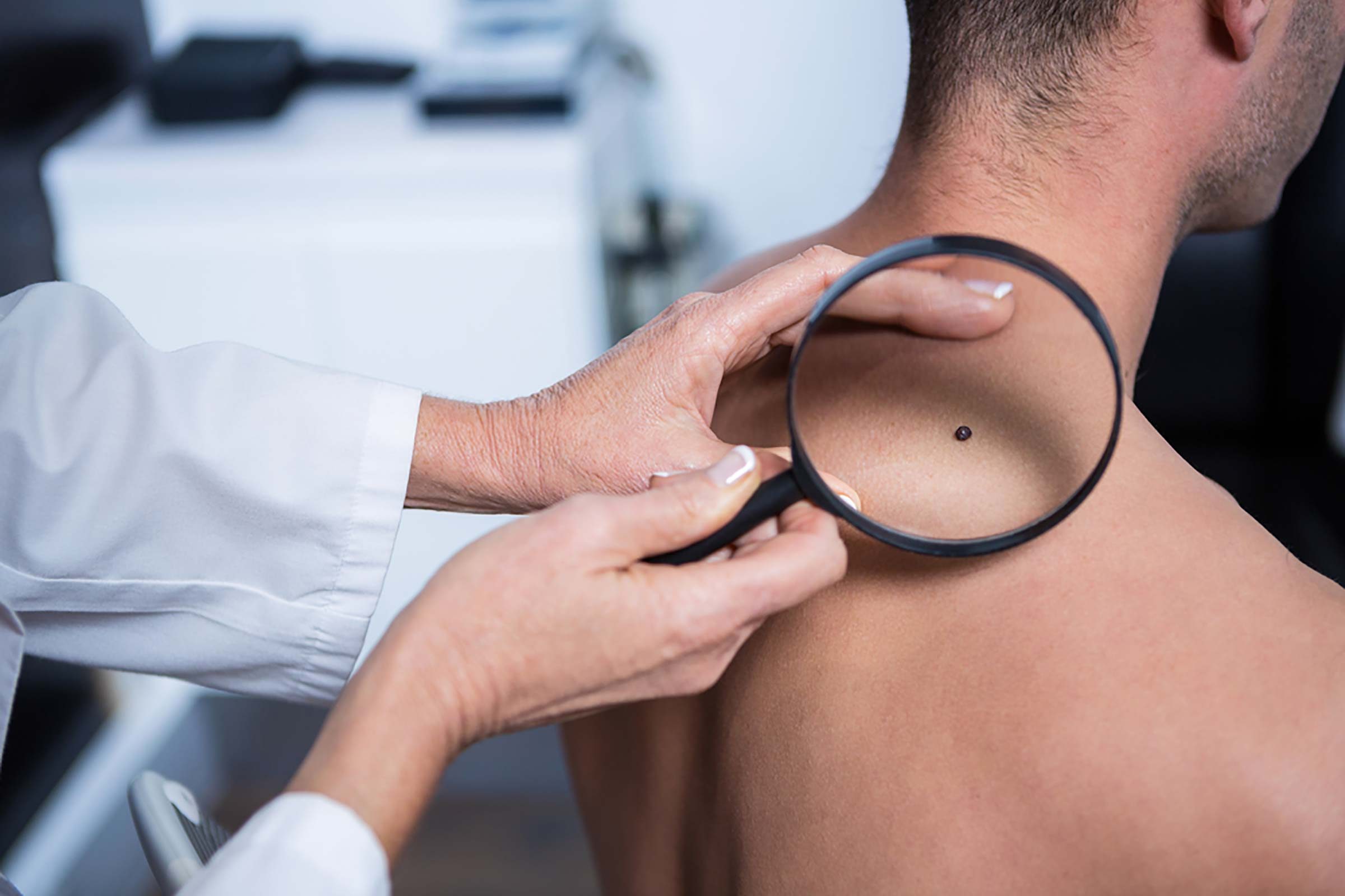 doctor examining mole
