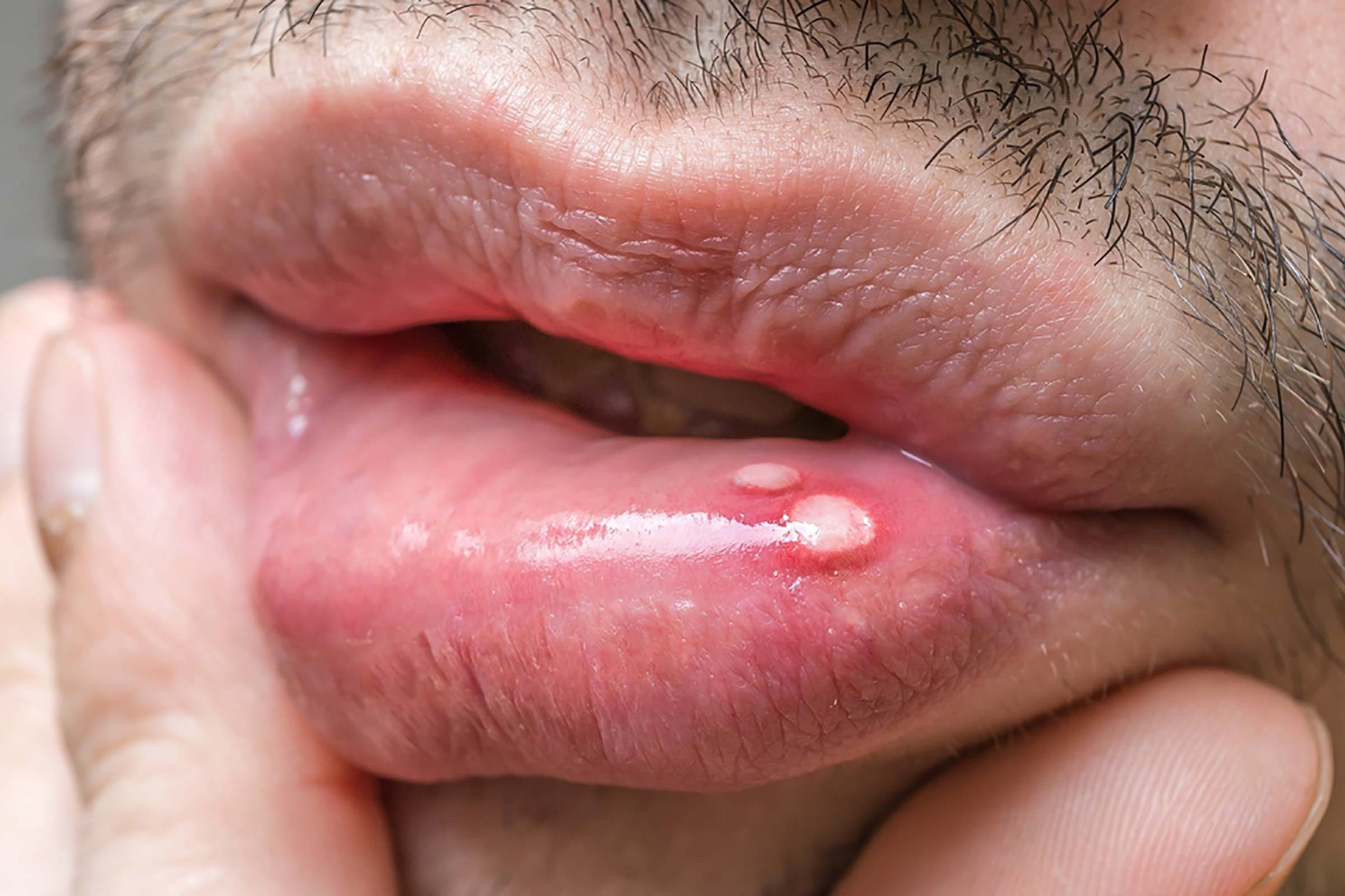 cold sore