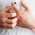The Best Eczema Cream for Your Type of Eczema
