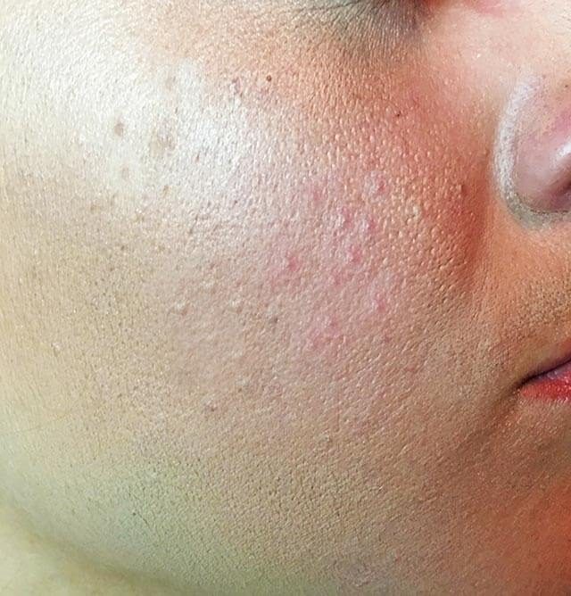 Acne