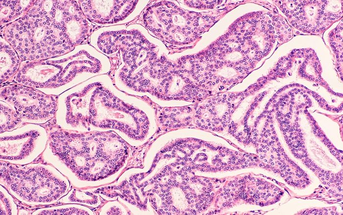 Breast-cancer