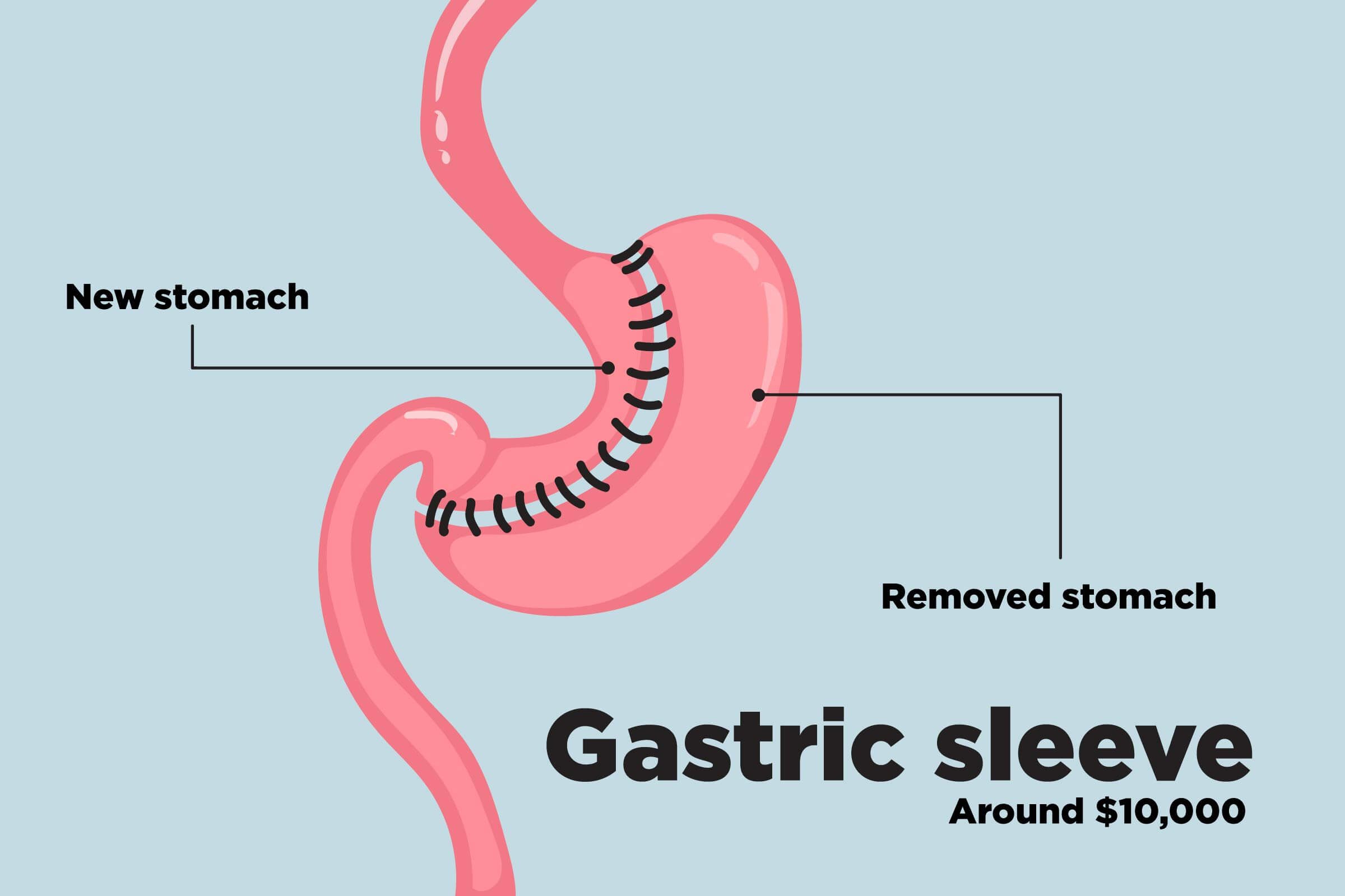 Top-Weight-Loss-Surgery-Procedures