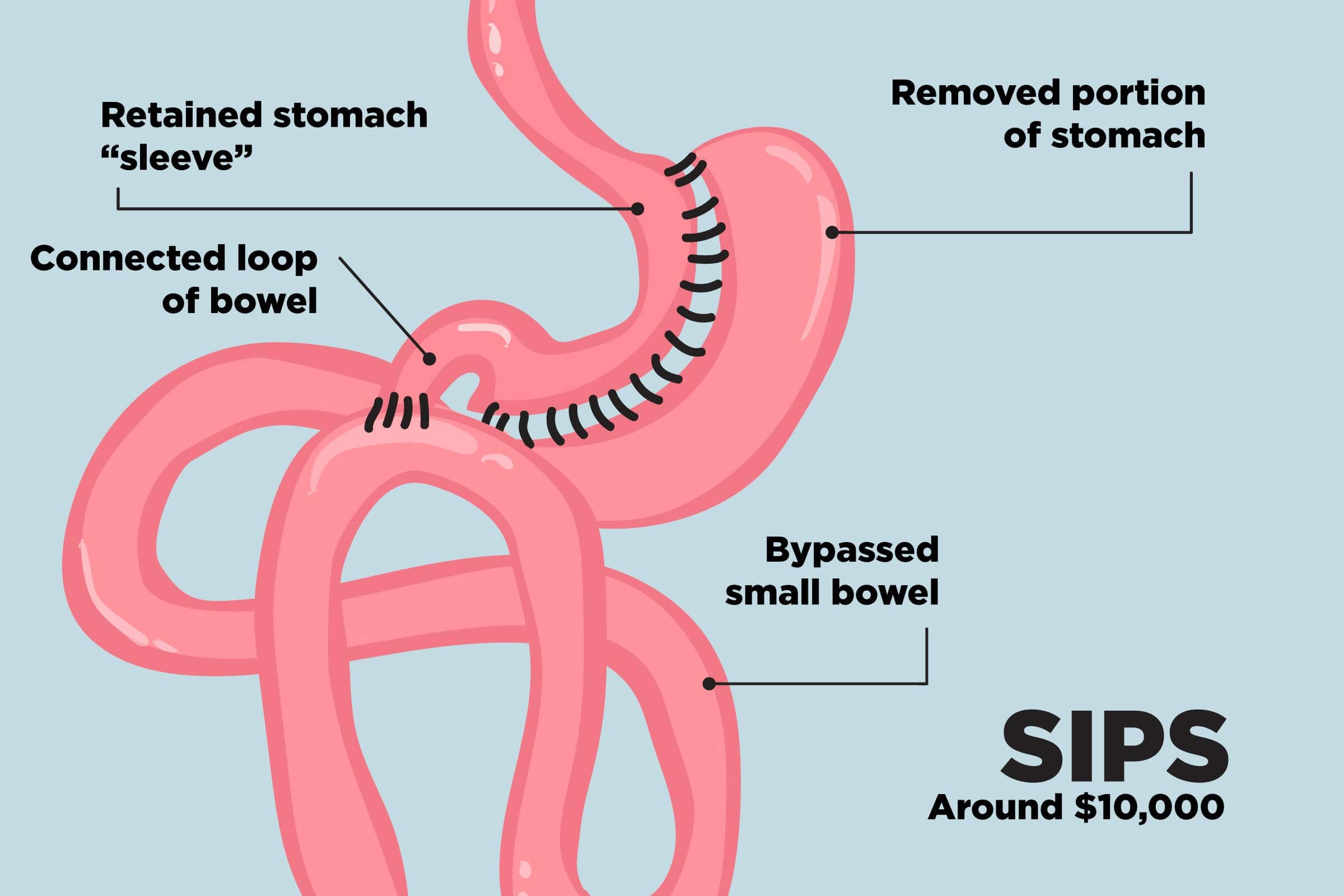 Top-Weight-Loss-Surgery-Procedures