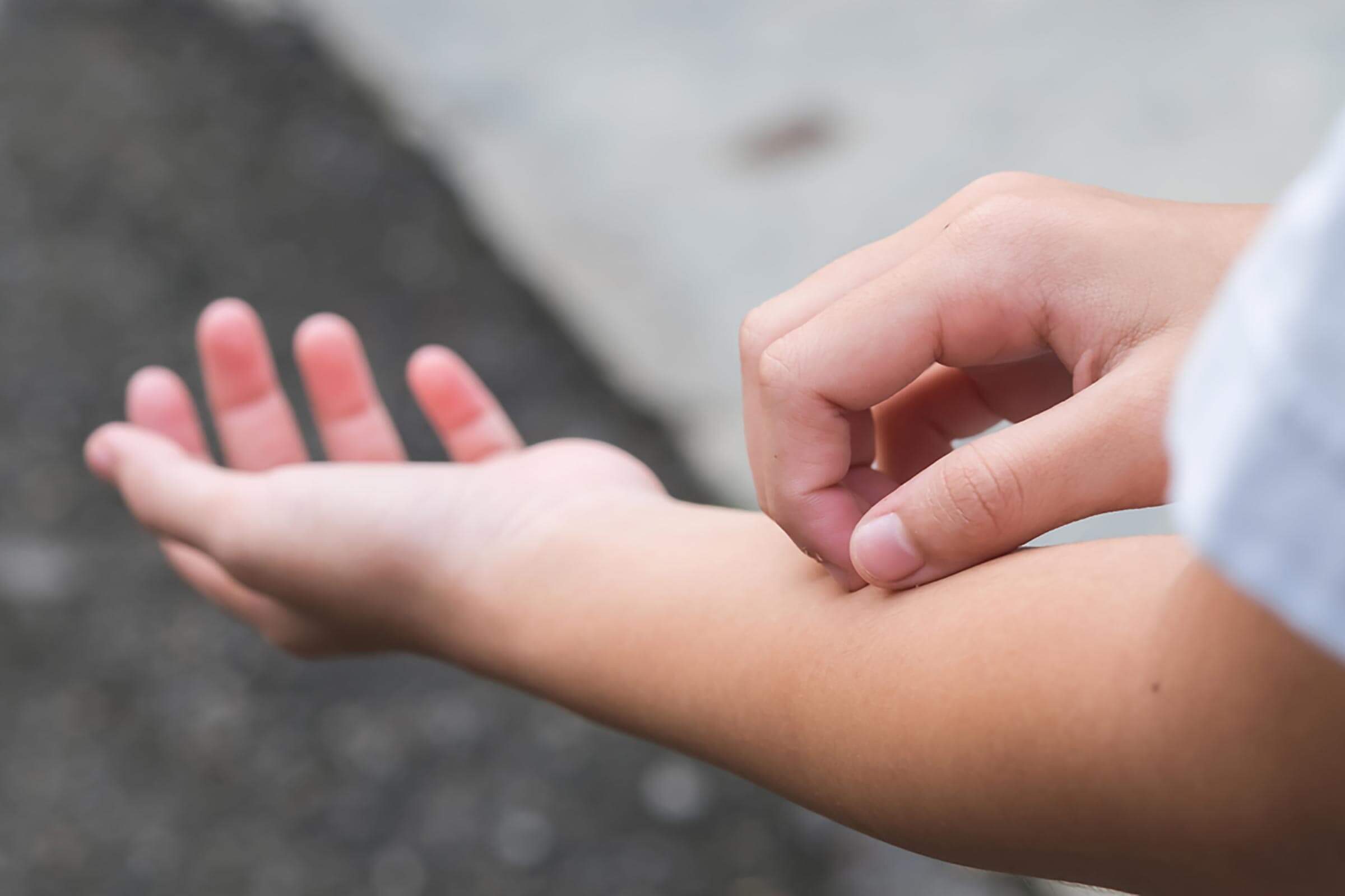 Eczema