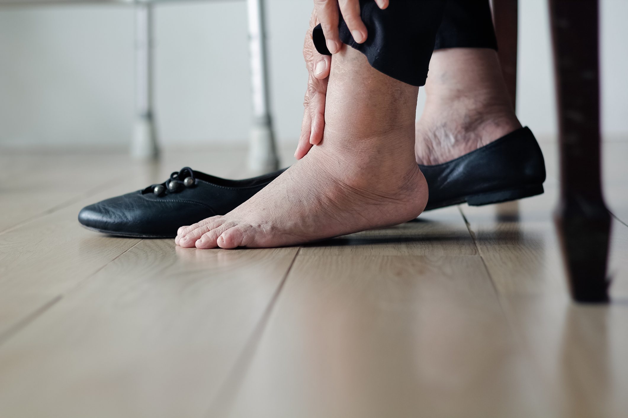 swollen feet insulin resistance