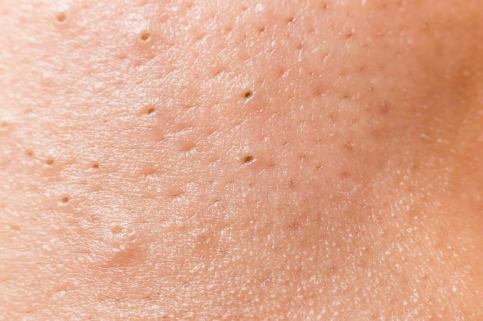 Blackheads on the face of a teenager