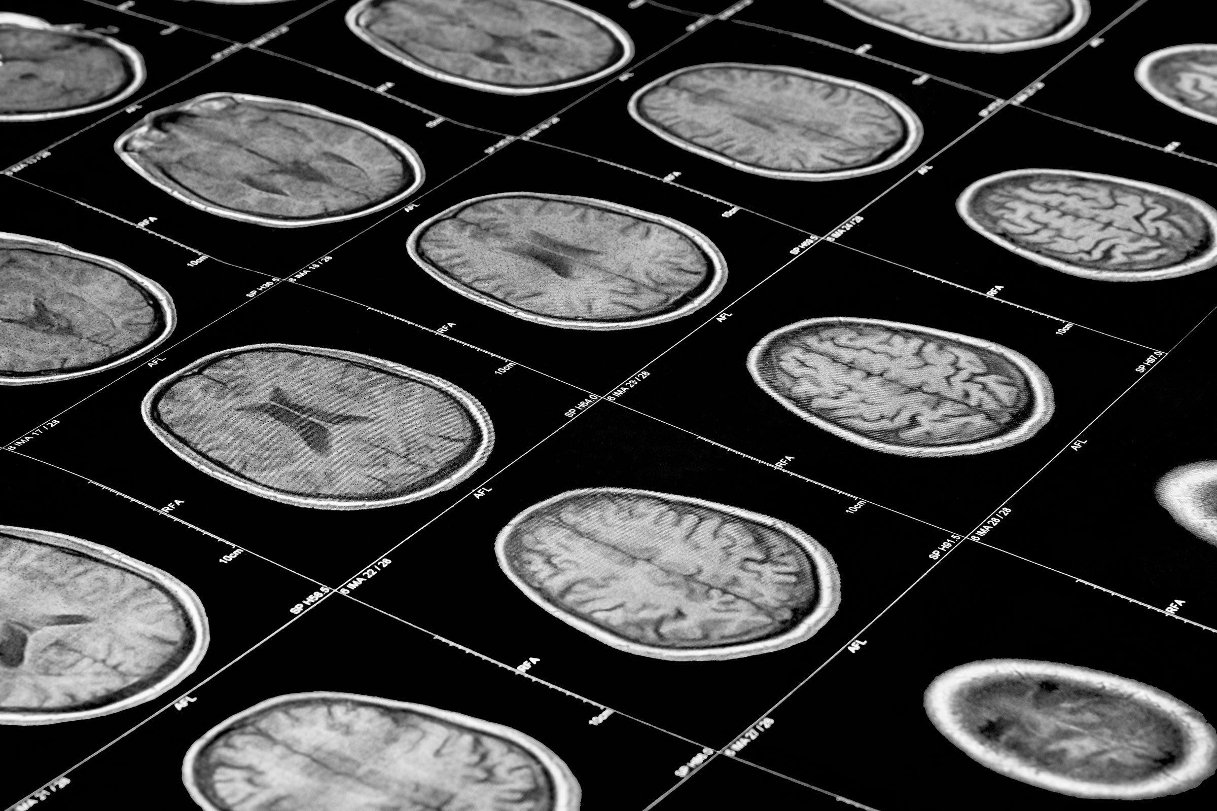 brain scan
