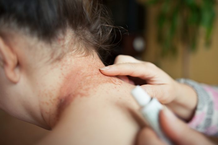 A nurse lubricating a person's neck with a healing eczema ointment.