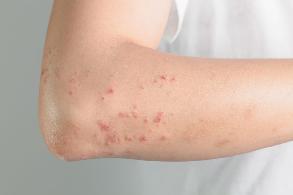 Atopic Dermatitis , allergic to chemicals,Itchy skin lesions from allergies, skin women.