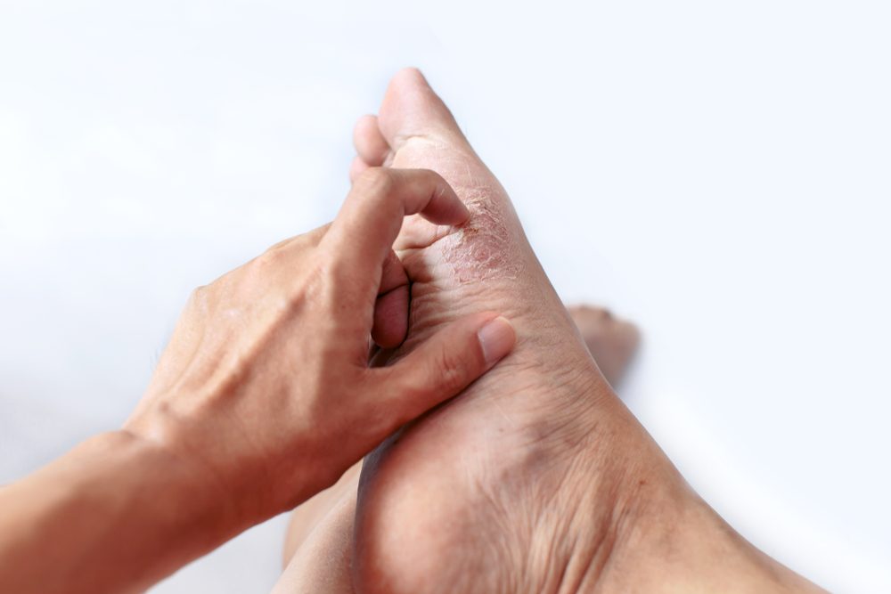 finger scratching at athlete's foot