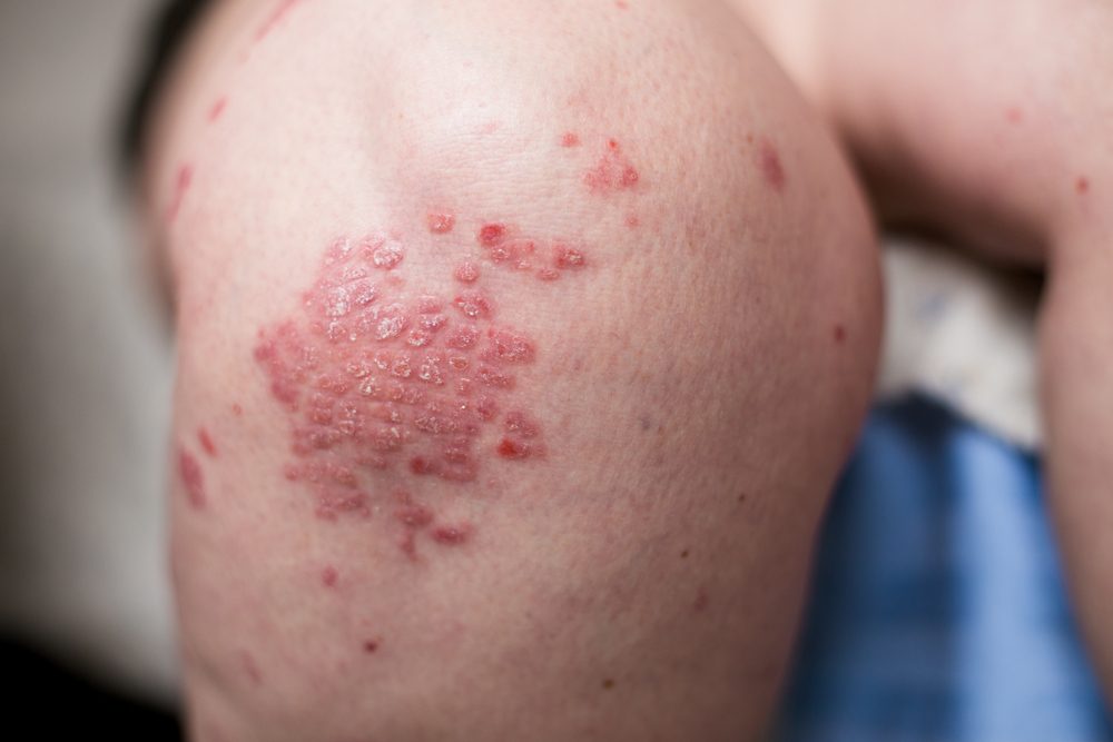 psoriasis on legs