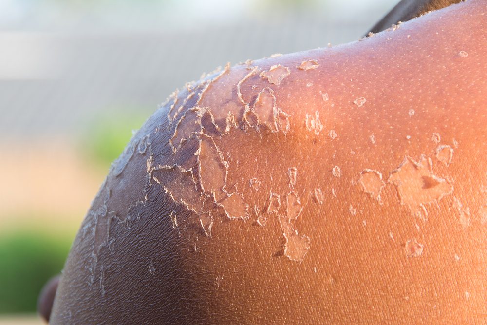 unburned peeling shoulder